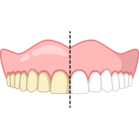 オフィスホワイトニング